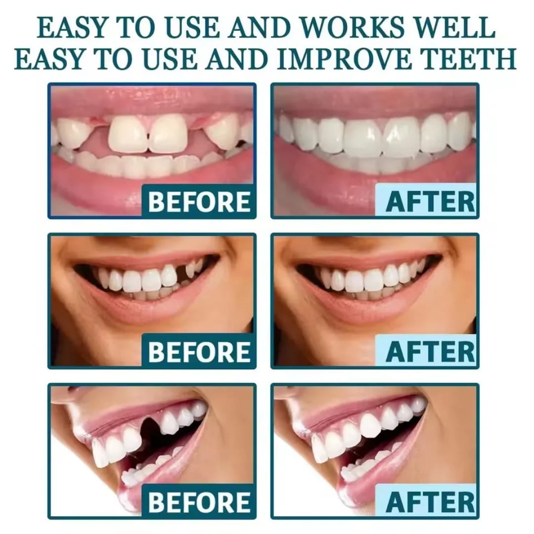 Prothèses dentaires Adjustable Snap-On Dentures